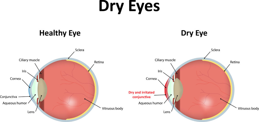The 10 Best Contact Lenses for Dry Eyes in 2024 22 AdobeStock 87639262