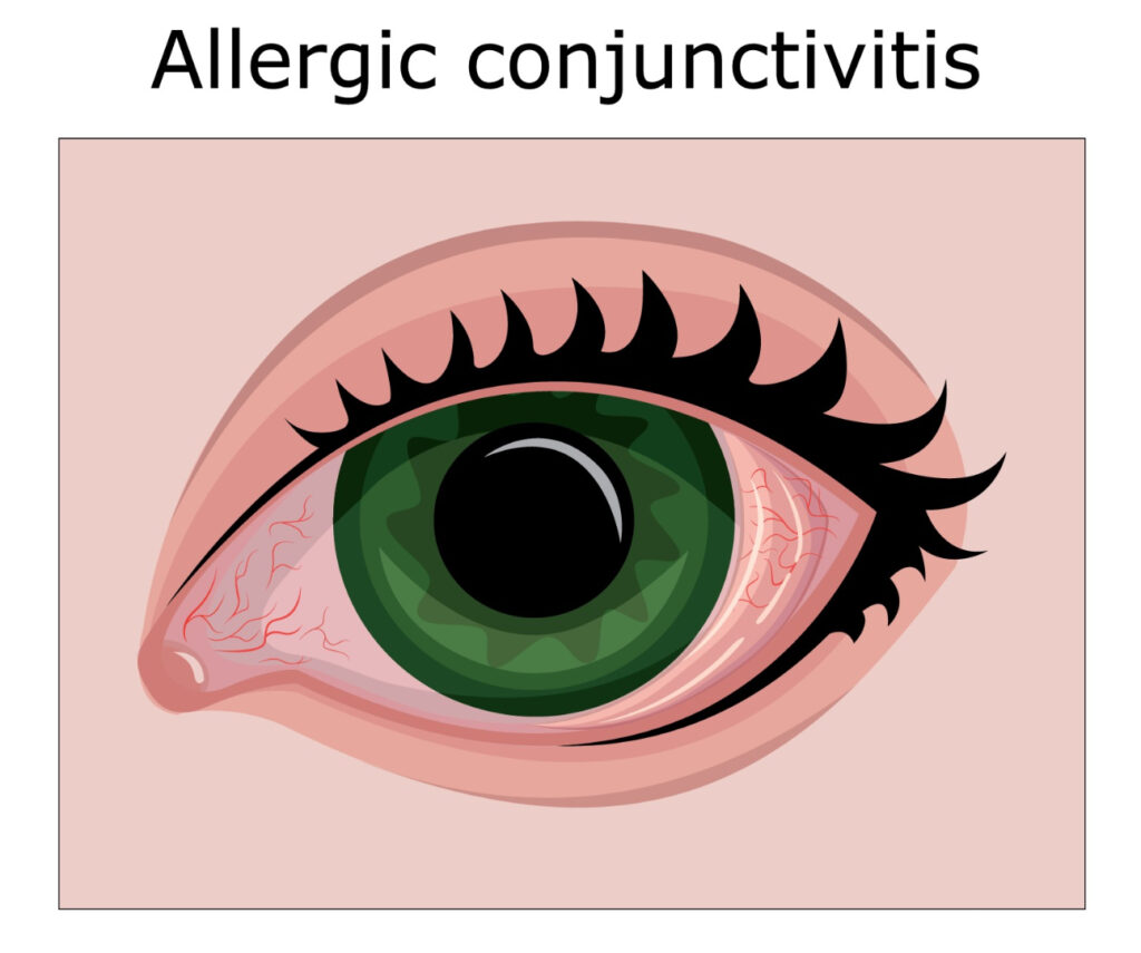 Pink Eye (Conjunctivitis) 8 allergic conjunctivitis