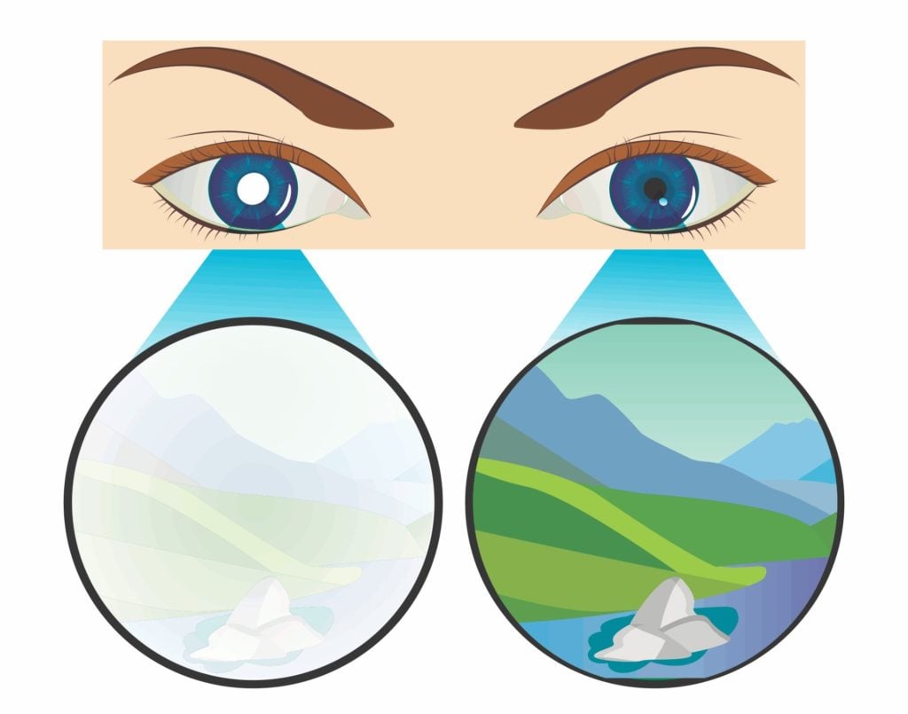 What to Expect With Amblyopia Surgery 4 lazy eye diagram