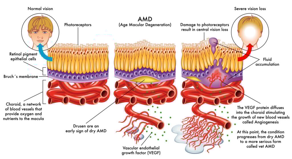 What is Age-Related Macular Degeneration? Causes, Prevention, & Treatment 7 AMD Macular degeneration flow chart