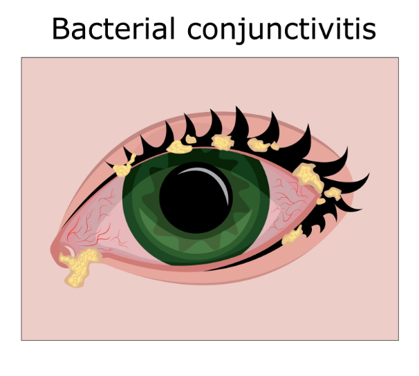 Pink Eye (Conjunctivitis) 7 Bacterial conjunctivitis