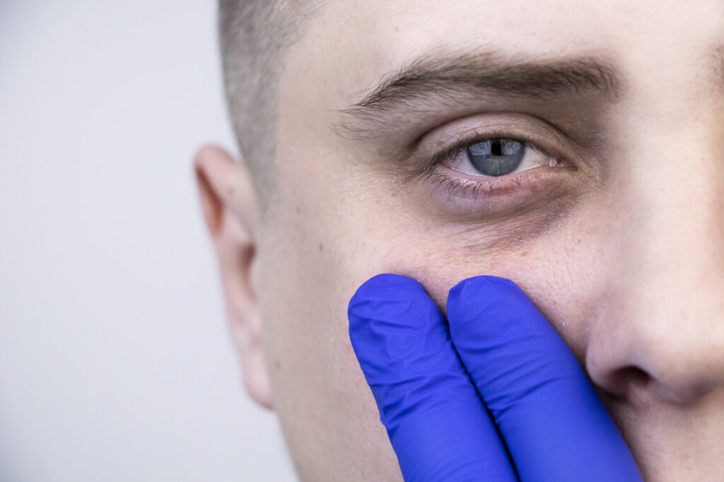 How to Treat Bags Under Your Eyes 2 Bags under the eyes as shown by a stressed man with two fingers pointing at the area