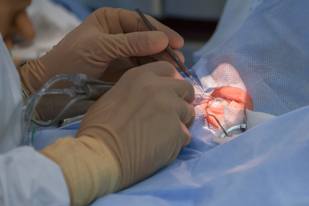 What Are Intraocular Lens Implants (IOLs)? 4 Bimanual cataract extraction with IOL implantation