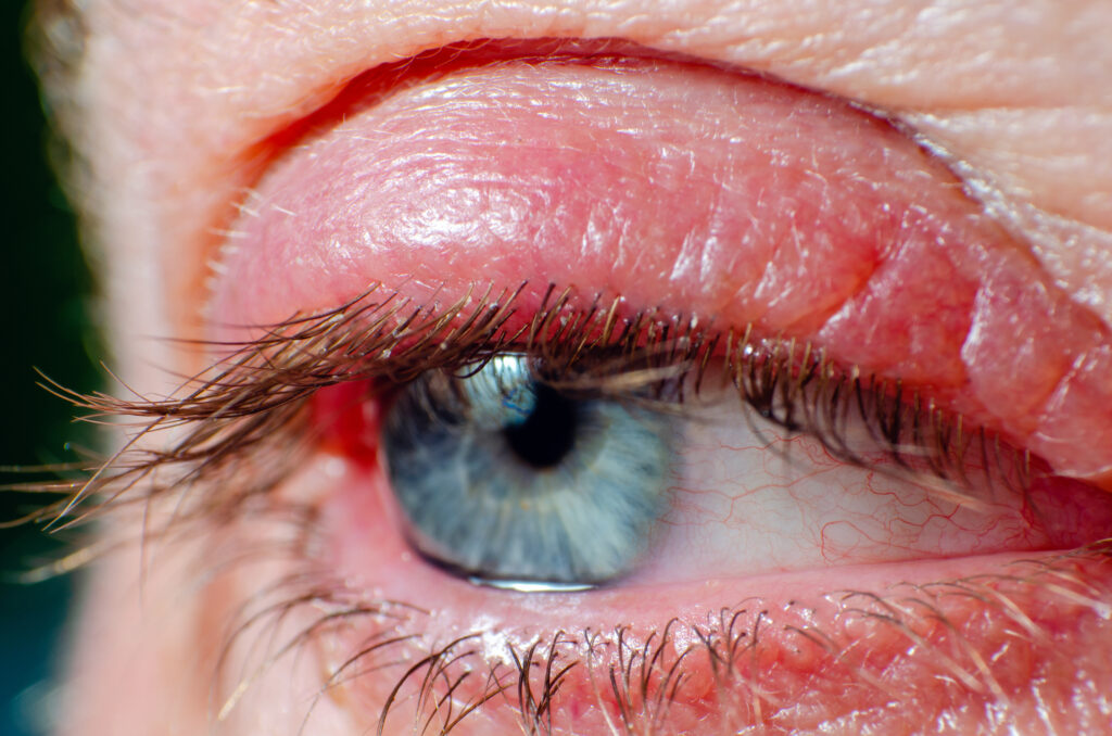 What Is Blepharitis? 6 Blepharitis 1