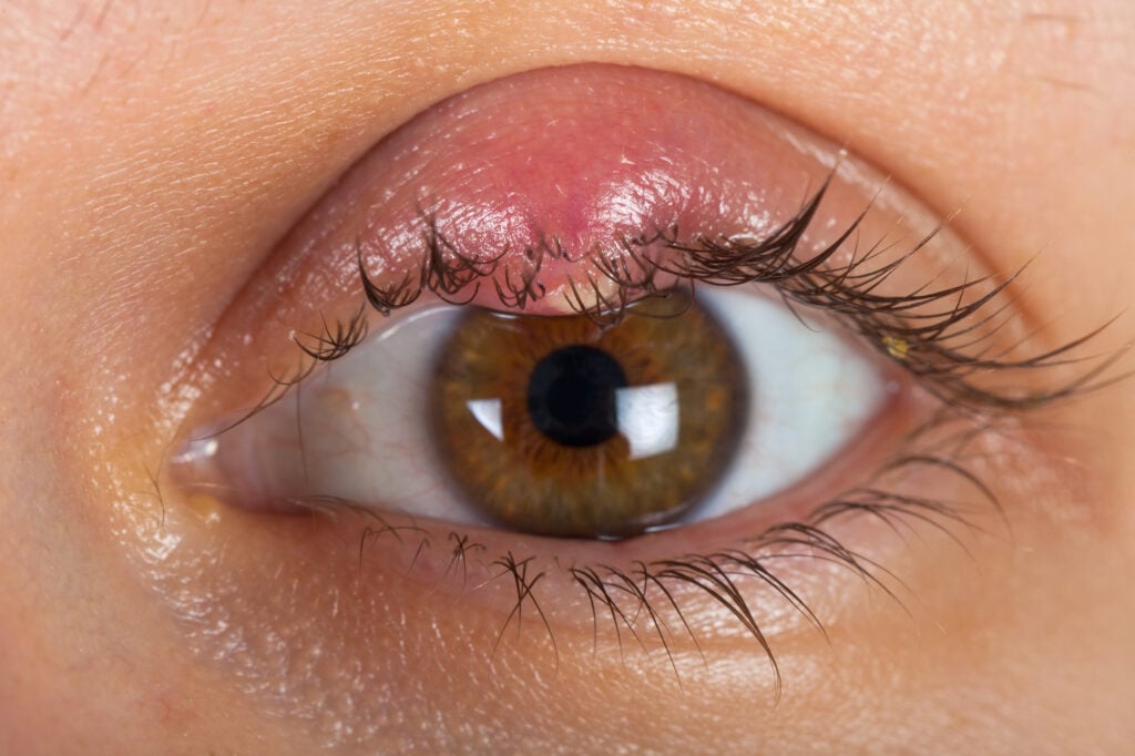 What Is Blepharitis? 7 Blepharitis 2