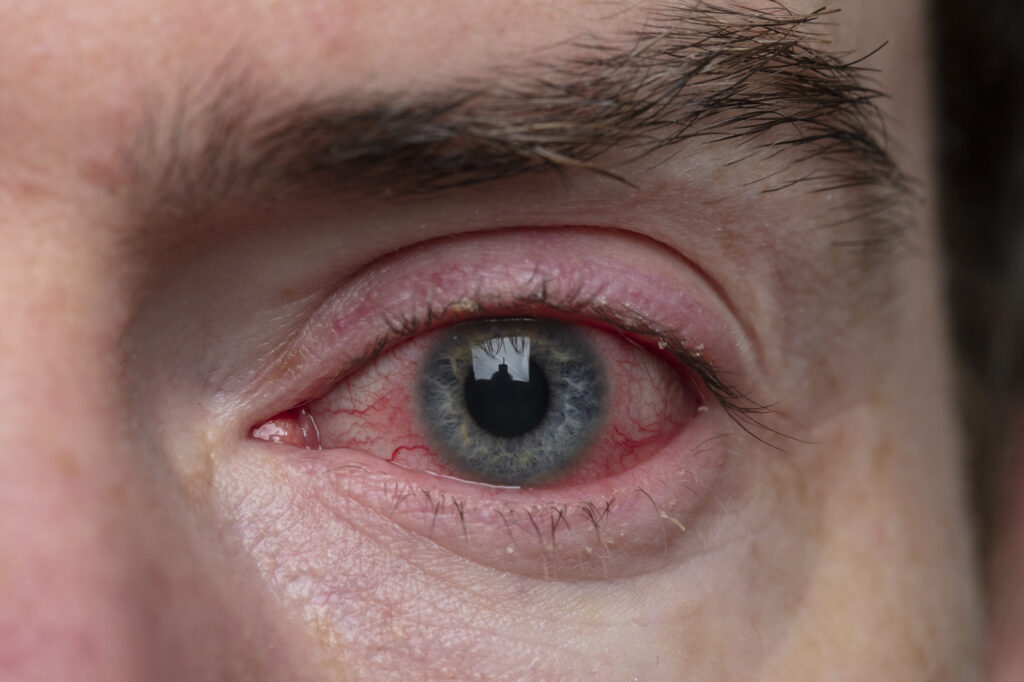 What Is Blepharitis? 8 Blepharitis 3
