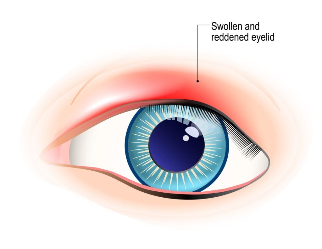 What Is a Chalazion and How Can You Treat It? 4 chalazion