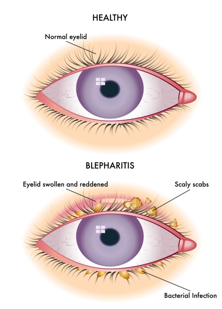 What Is Blepharitis? 5 Colorful Blepharitis scheme or illustration comparing against a normal eye