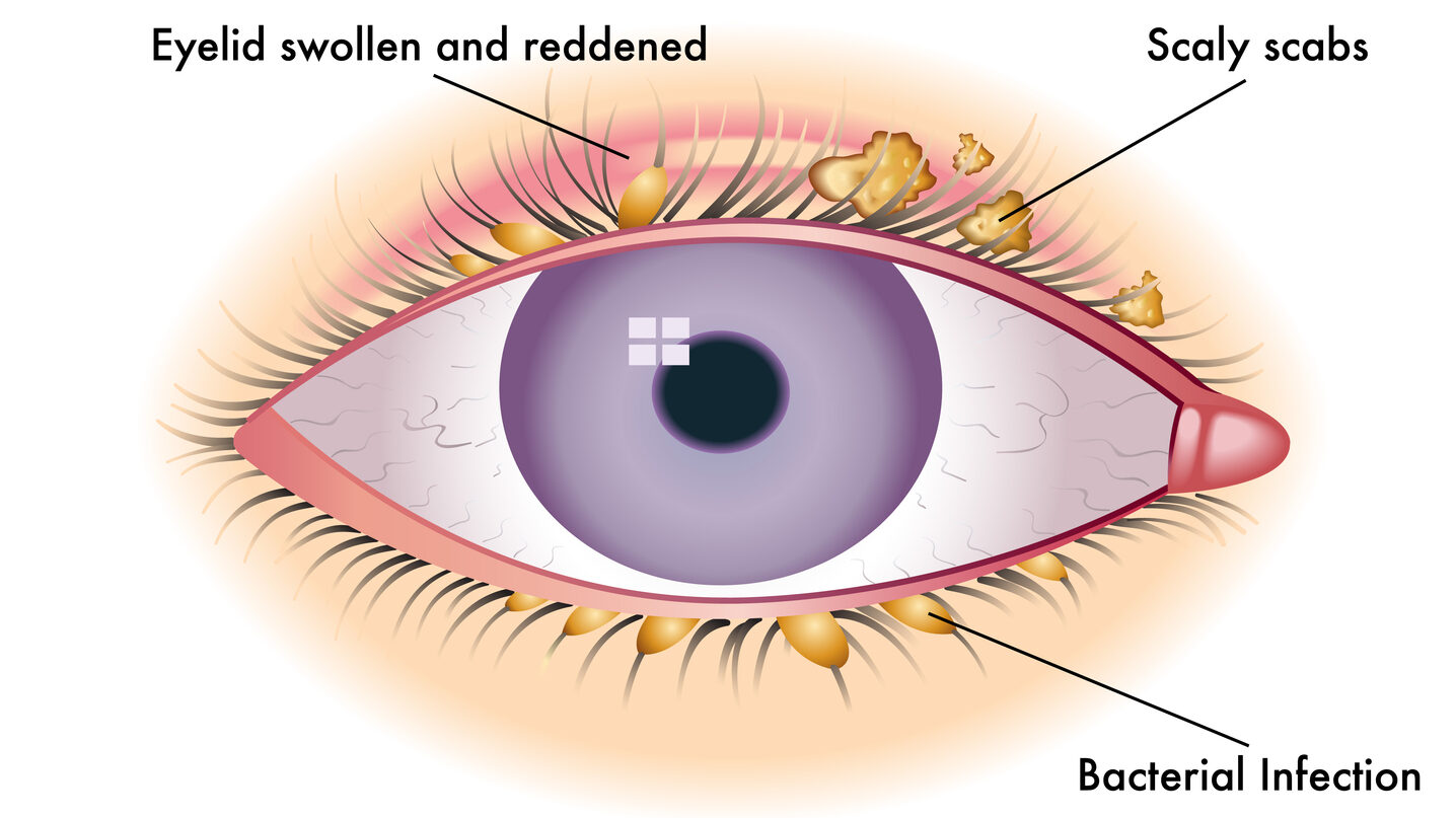 Burning Eyes: Symptoms, Causes, and More 6 Colorful Blepharitis scheme or illustration comparing against a normal eye edited