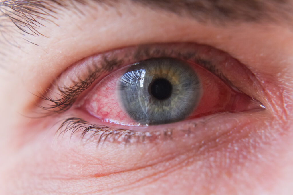 Pink Eye (Conjunctivitis) 5 Conjunctivitis or pink eye close up on eye