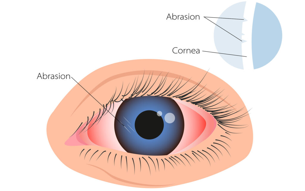 Corneal Abrasion: Understanding Scratched Cornea 3 Corneal Abrasion illustration edited