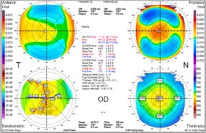 Custom Lasik (Wavefront-Optimized, Wavefront-Guided, Topography-Guided) 5 corneal topography