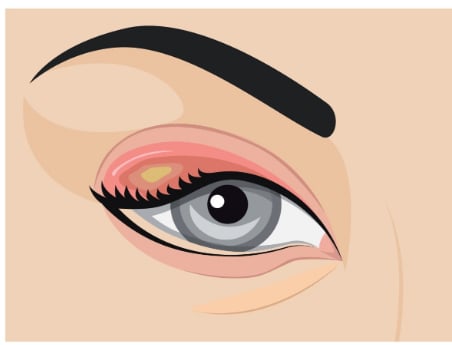 What Is a Chalazion and How Can You Treat It? 3 eye stye