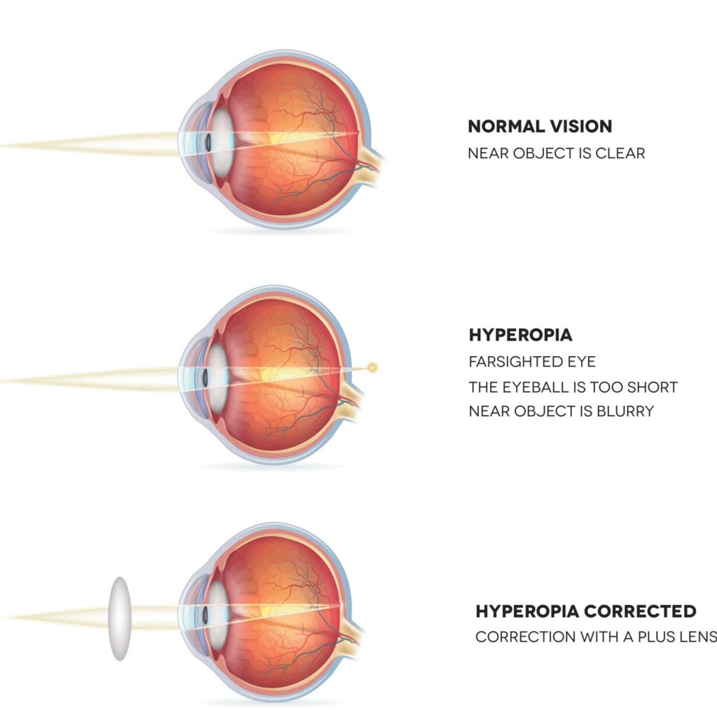 Is LASIK Safe for Farsightedness? Here’s What to Expect 3 diagram comparing normal vision, hyperopia, and hyperopia corrected