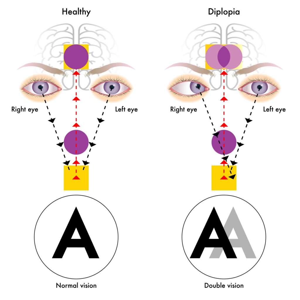 What is Double Vision? Causes, Symptoms, Treatment, Prevention 3 Illustration depicting Diplopia or double vision and Healthy Eye vision comparison