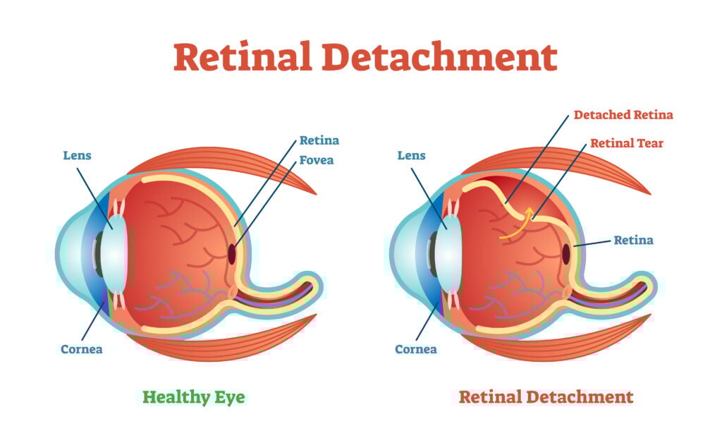 Vitreous Humor - Anatomy & Function 6 Illustration of a healthy eye vs an eye suffering Retinoschisis or retinal detachment or the separation of retina
