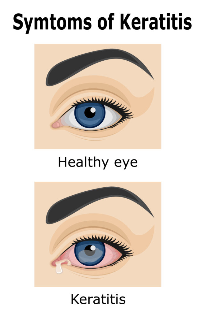 What to Know About Keratitis 4 Illustration of Keratitis