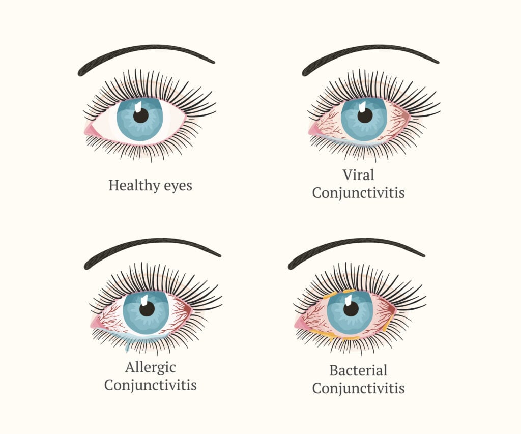 What Causes Eye Pain? Is It Dangerous? 9 Illustration of types of Conjunctivitis in the eyes