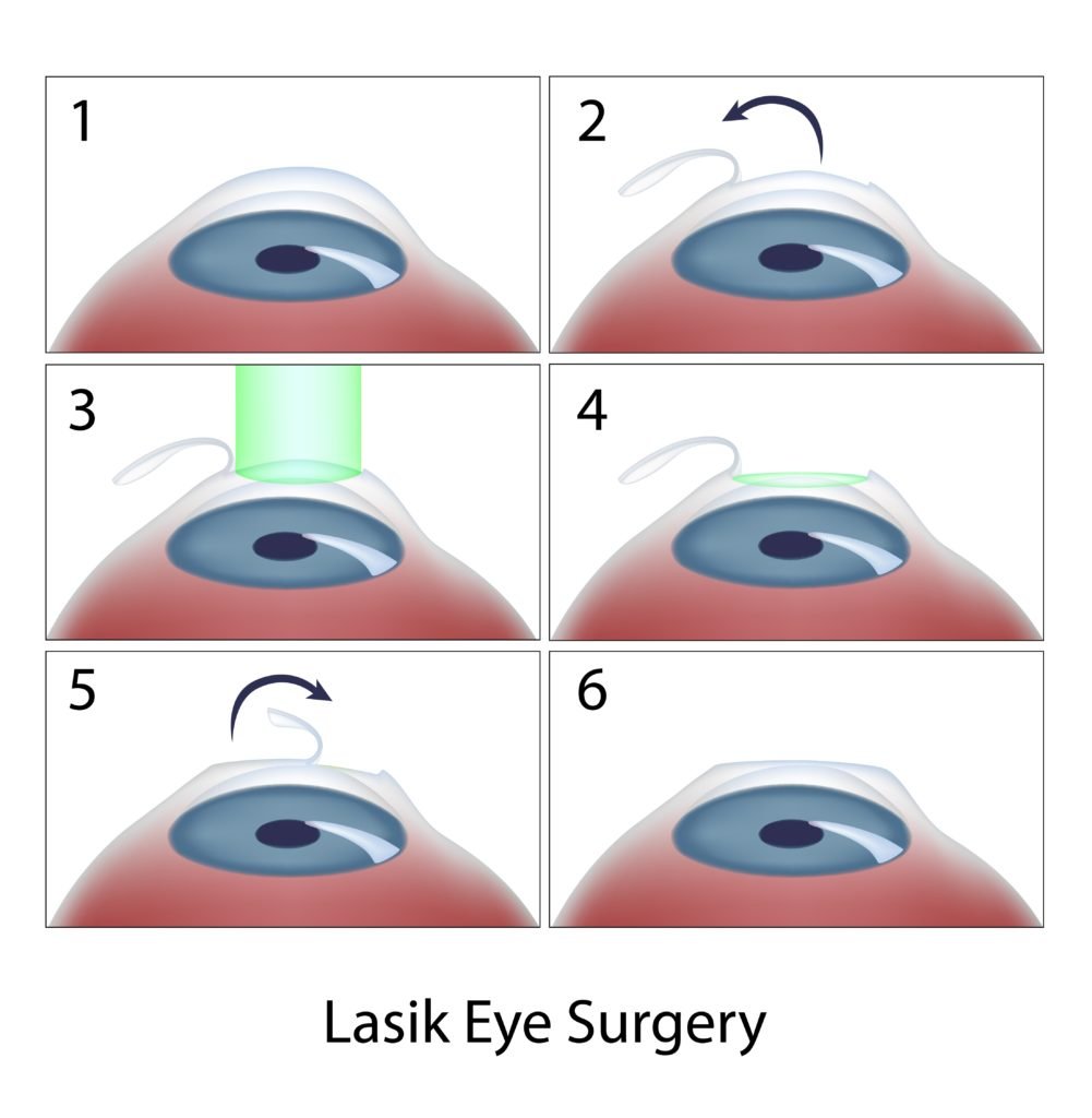 How Long Does LASIK Surgery Take? 4 diagram showing six steps of lasik eye surgery