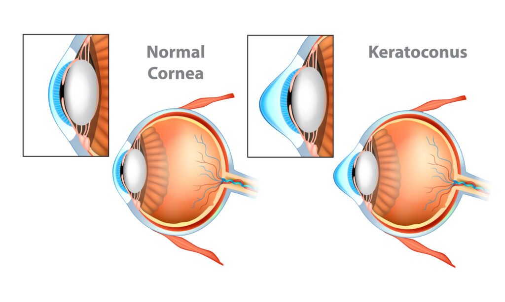 What to Expect After Keratoconus Surgery 3 normal cornea vs Keratoconus eye
