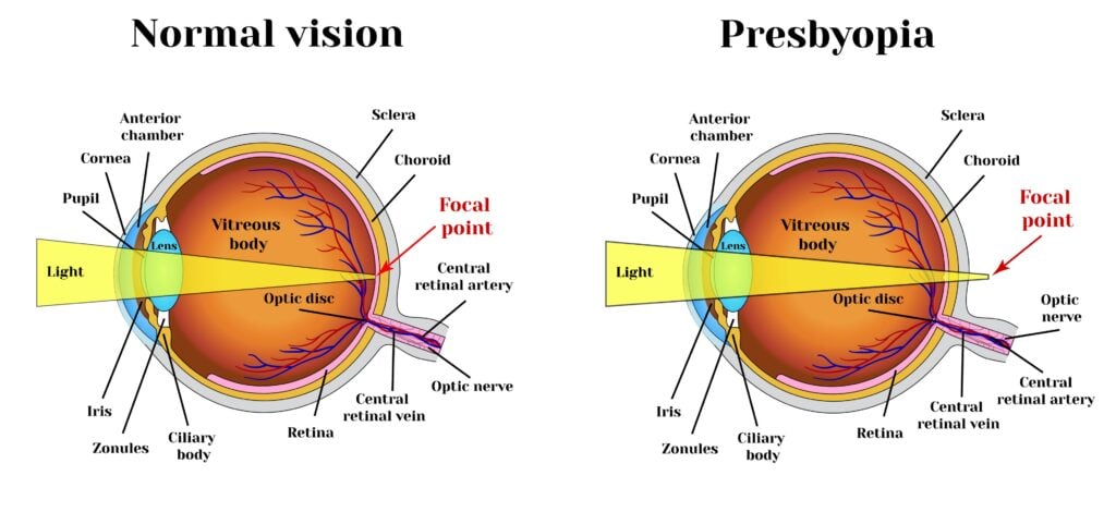 How Aging Can Change Your Vision 6 graphic showing normal eye and presbyopia