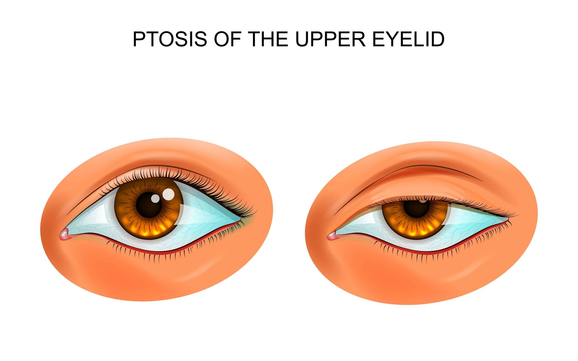 Droopy Eyelids (Ptosis) 3 Ptosis or Droopy Eyelid Illustration edited
