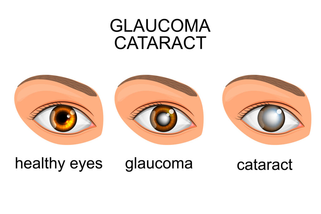 What is Contrast Sensitivity? 3 Refractive errors illutration