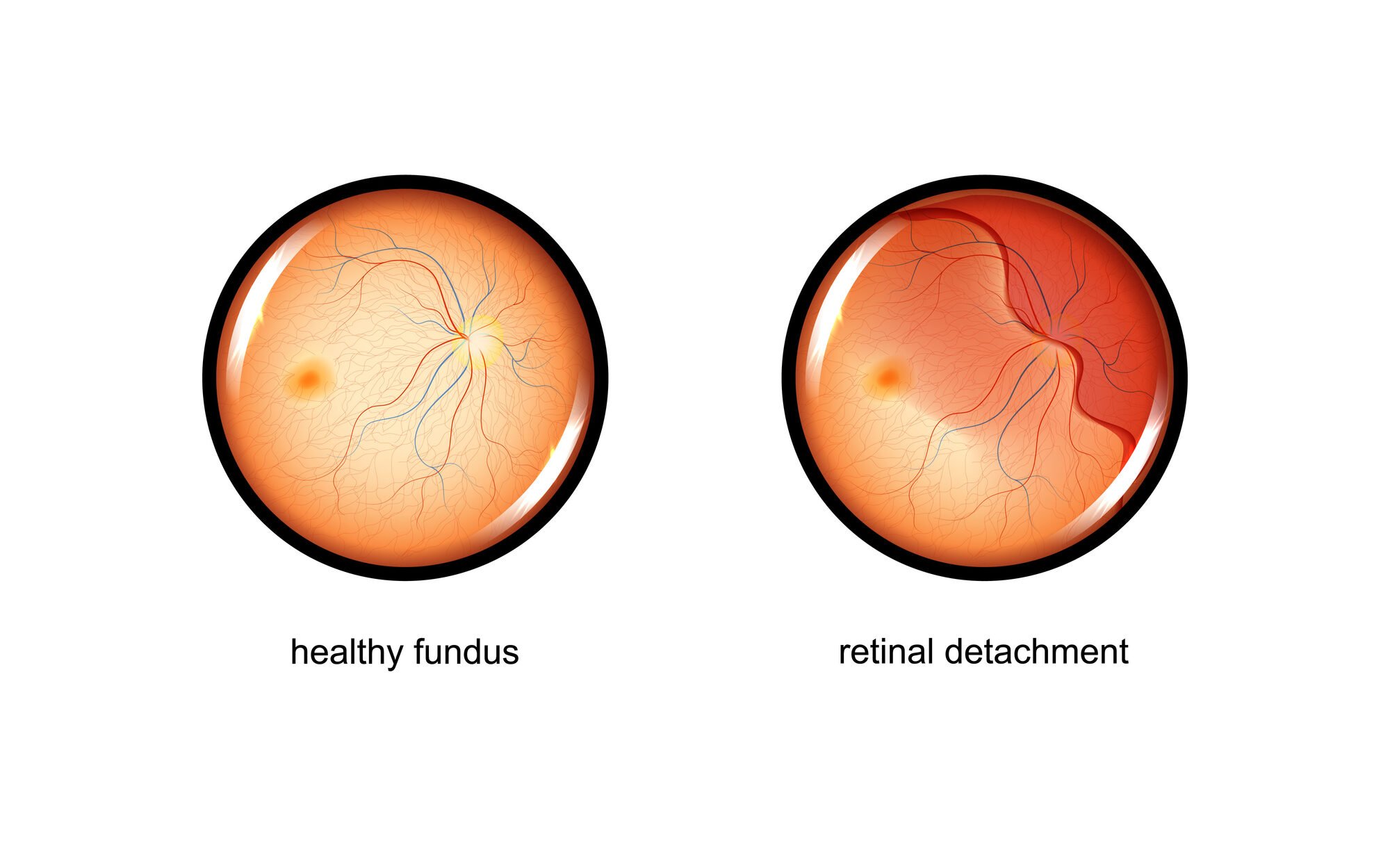Retinal Tear Causes, Symptoms & Treatments 2 retinal detachment 1 edited