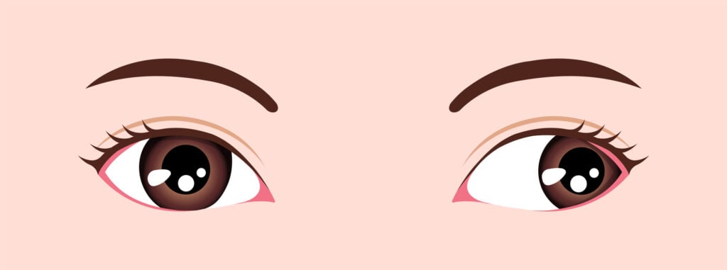 What Is Strabismus? (Crossed Eyes) 3 Type of strabismus vector illustration Exotropia