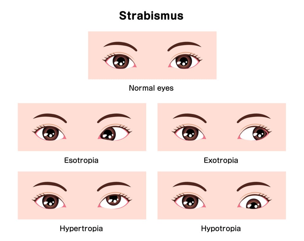 Strabismus Surgery 4 Types of strabismus vector illustration