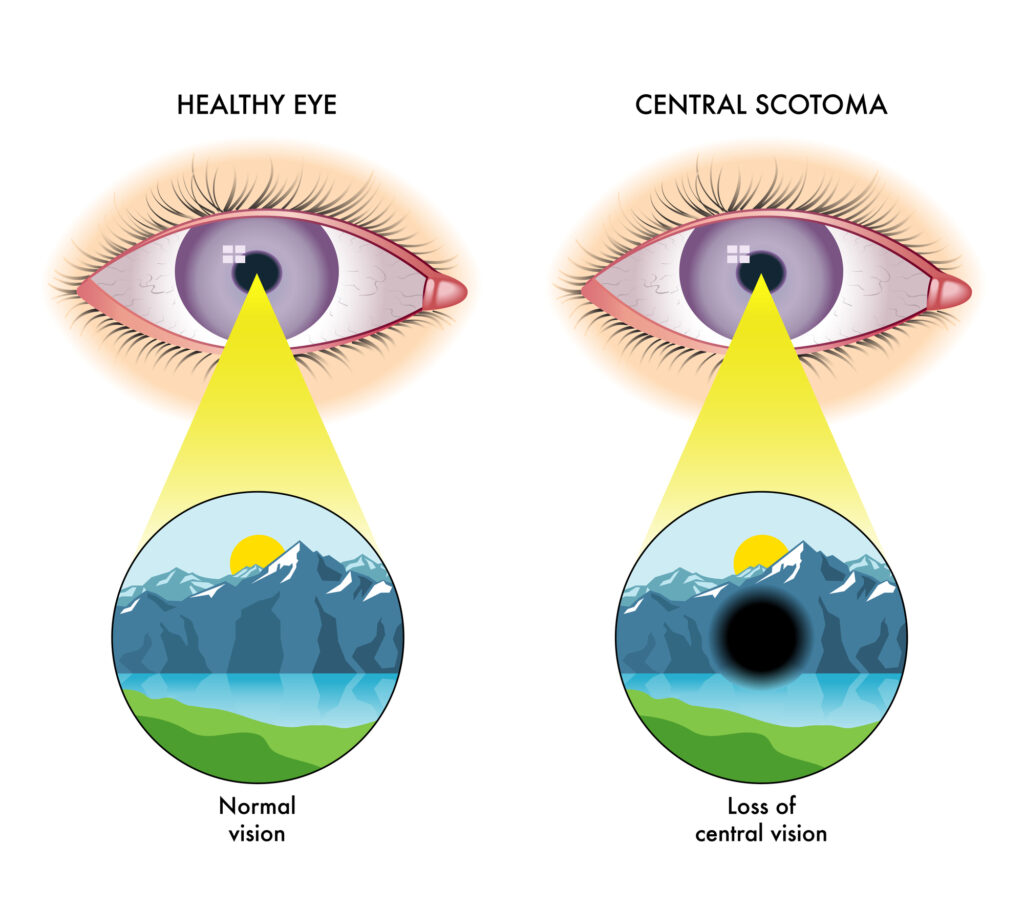 A Closer Look at Scotoma (Blind Spot in Vision) 4 Vector illustration of central scotoma
