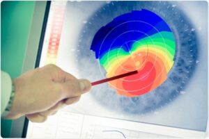Custom Lasik (Wavefront-Optimized, Wavefront-Guided, Topography-Guided) 6 Wavefront Aberrometry