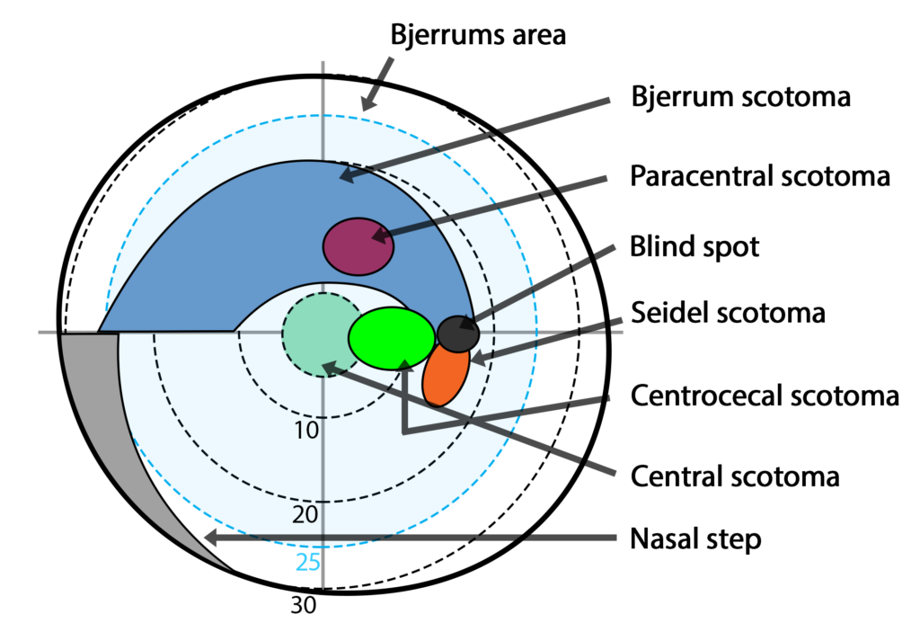 A Closer Look at Scotoma (Blind Spot in Vision) 3 Bjerrums area and types of scotomas on the visual field