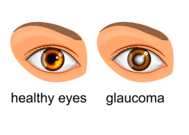 What Is Glaucoma Surgery? 3 Glaucoma Vector