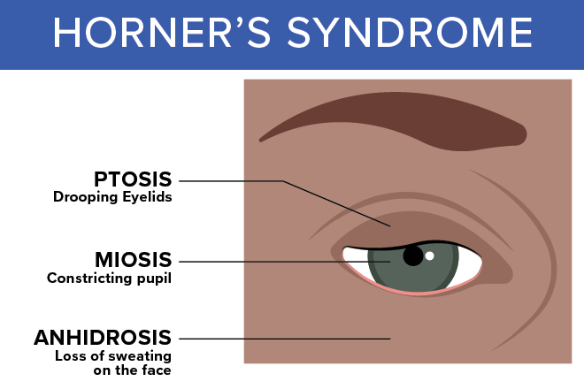 What is Horner's Syndrome? 2 Horners syndrome