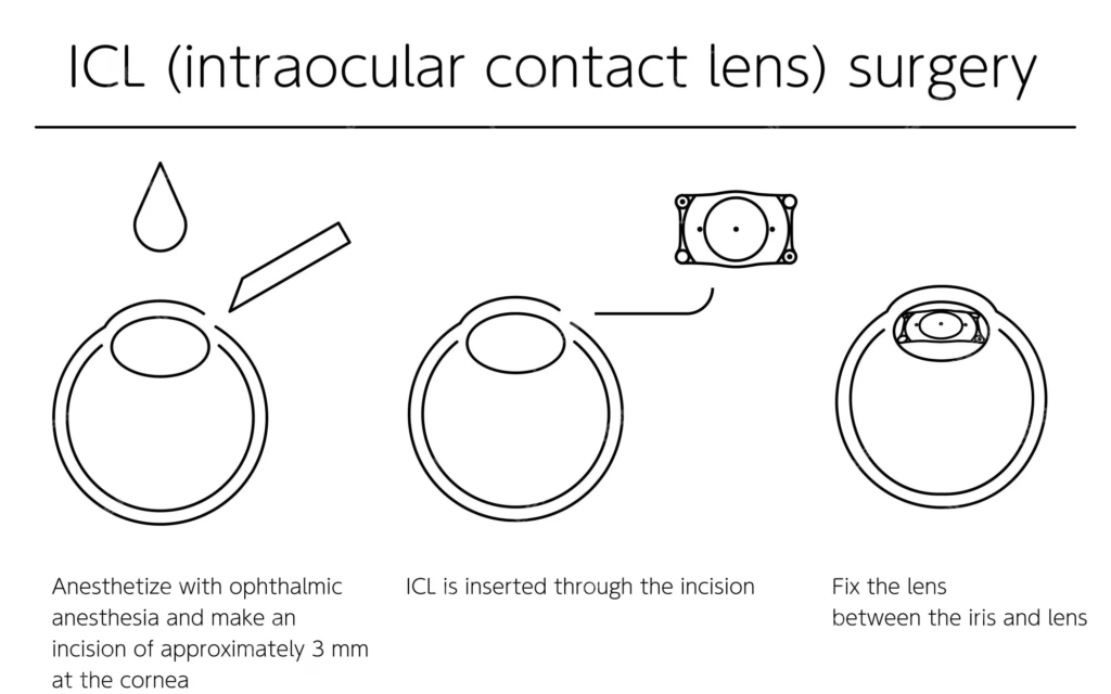 ICL Surgery: What to Expect and More 4 ICL or Intraocular Contact Lens Surgery Illustrateion
