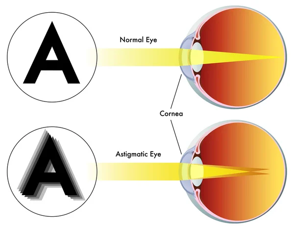 How Long Is the Recovery Time for LASIK? 4 image 1