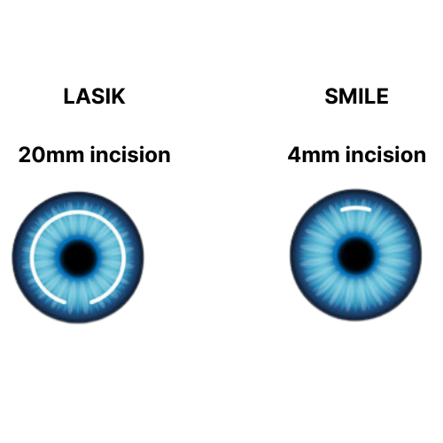 What to Expect Before, During, and After SMILE Eye Surgery 4 LASIK vs SMILE procedure illustration