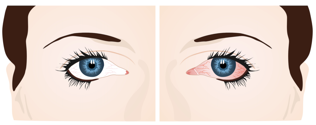 Burning Eyes: Symptoms, Causes, and More 5 Normal eye vs Burning Eye
