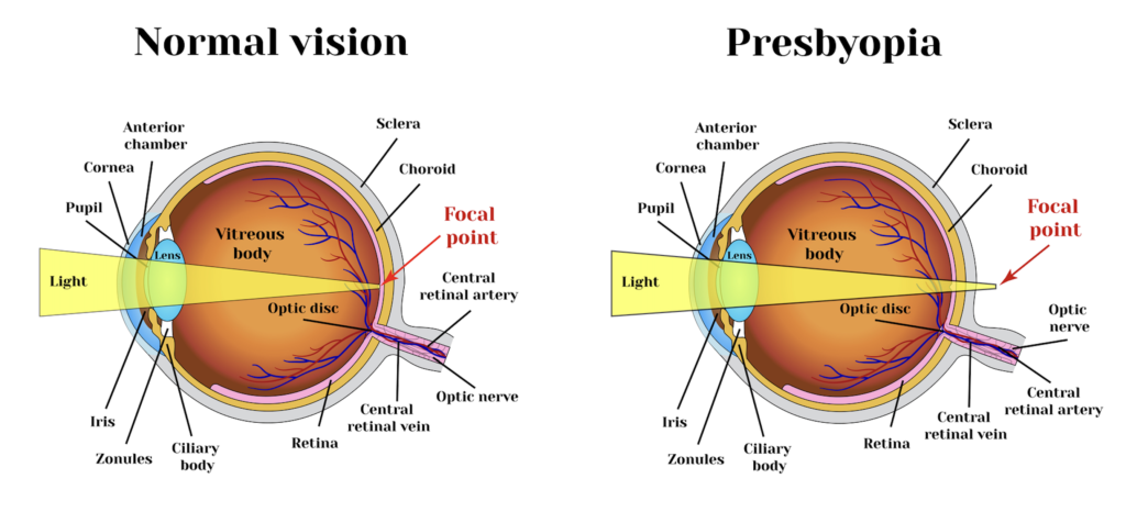 Presbyopia Surgery: What Are Your Options 2 Presbyopia illustration