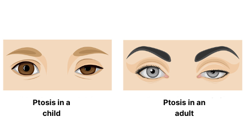 Droopy Eyelids (Ptosis) 4 ptosis symptoms edited
