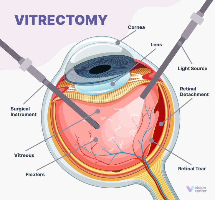 Vitreous Humor - Anatomy & Function 5 vitrectomy infographic